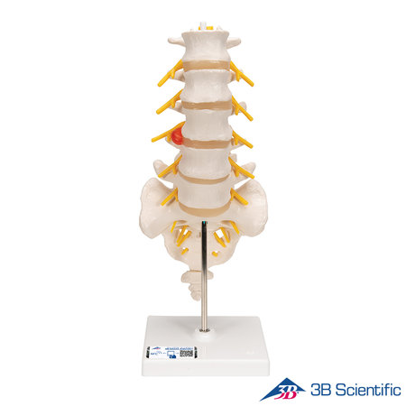 3B Scientific 인체모형 A76/5 후외측 배측방 디스크 요추