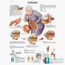 3B Scientific 관절염 인체해부차트 VR1123 Arthritis 관절염차트_액자추가