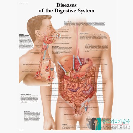 3B Scientific 소화기질병 인체해부차트 VR1431 소화계질환 병원액자_액자없음