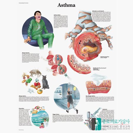 3B Scientific 천식 인체해부차트 VR1328 Asthma 천식차트 병원액자_액자추가