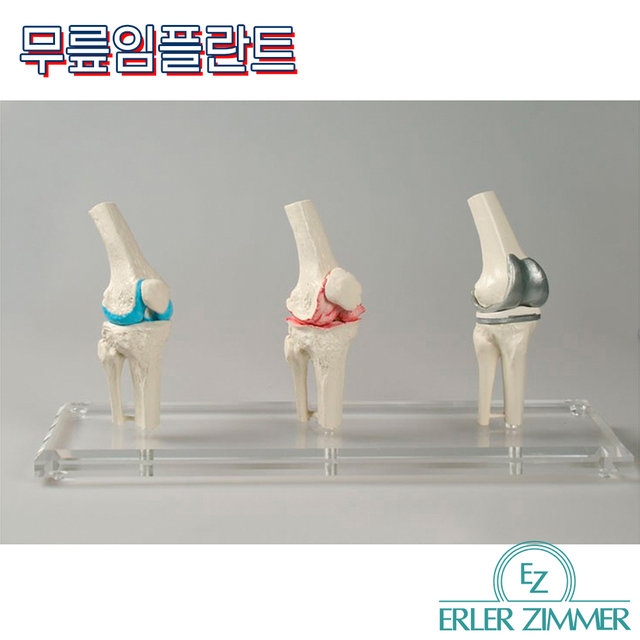 ERLER ZIMMER 인체모형 1125 무릎임플란트 3단계 무릎인공관절