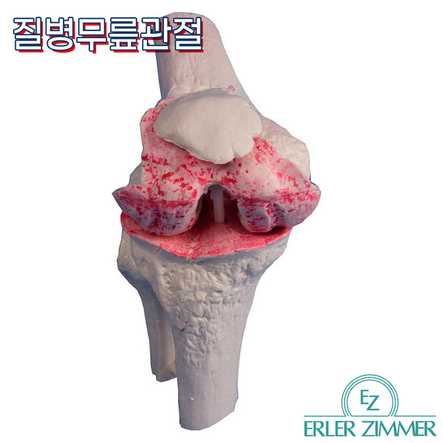 ERLER ZIMMER 인체모형 1125 무릎임플란트 3단계 무릎인공관절