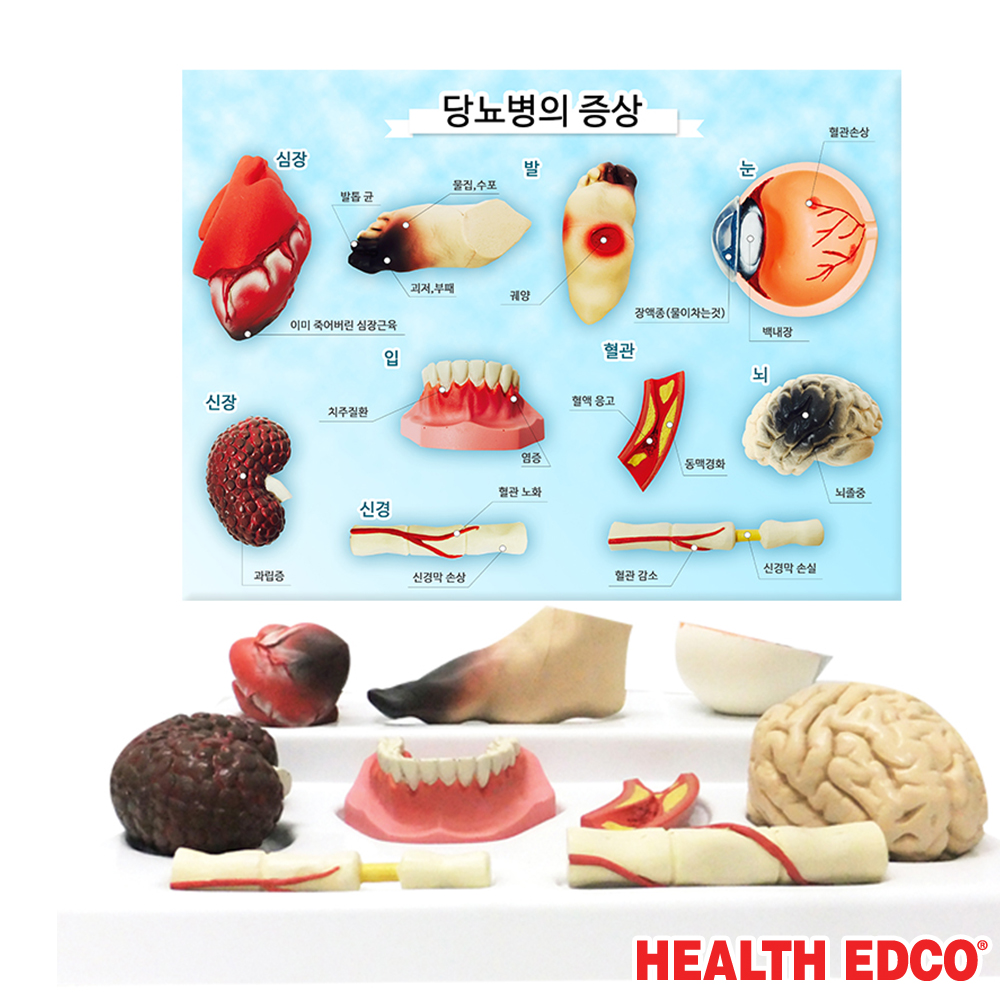 HEALTH EDCO 종로의료기 HEALTH EDCO USA 3D입체모형 78792 당뇨의증상 당뇨의위험성 교육교재